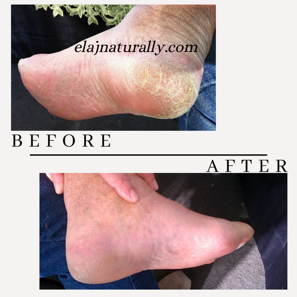 14 Day Soft Feet Challenge Kit