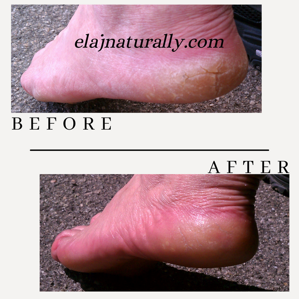 14 Day Soft Feet Challenge Kit